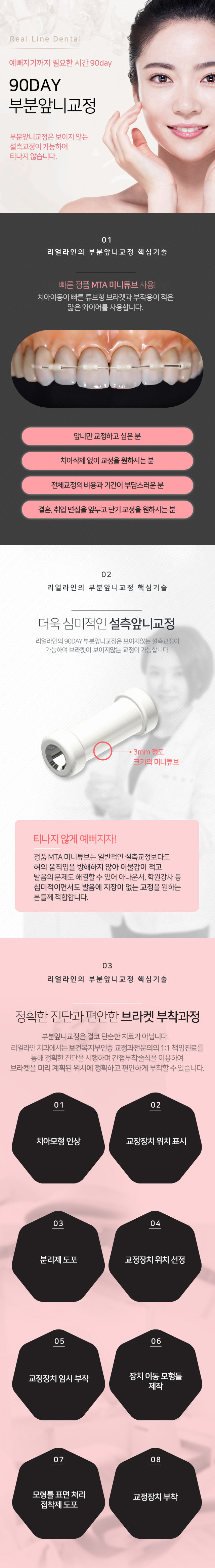 90DAY 급속앞니교정