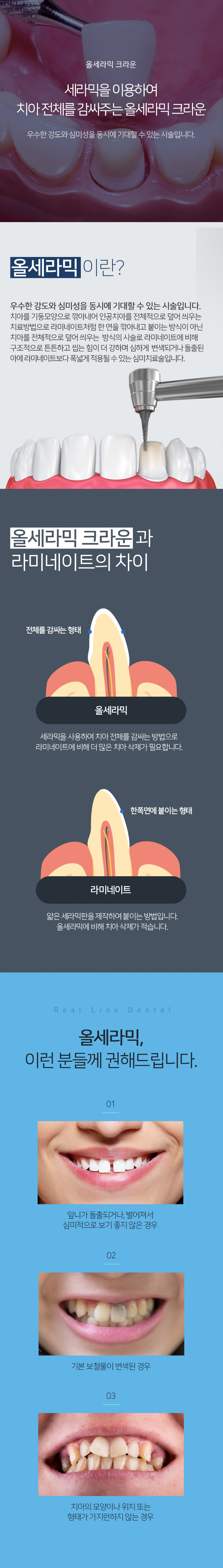 올세라믹 크라운